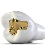 Füllungen, Inlays (Konservierende Versorg.)